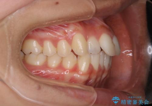 前歯のがたつきを改善してしっかり噛める歯並びへ:インビザライン治療の治療前