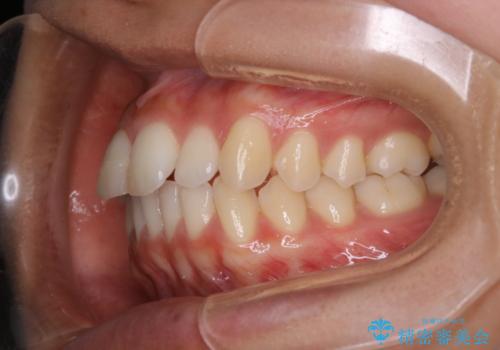 前歯のがたつきを改善してしっかり噛める歯並びへ:インビザライン治療の治療前