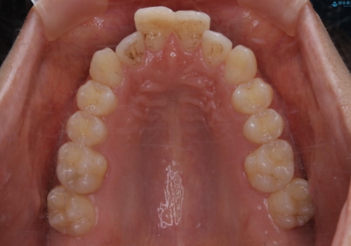 前歯のがたつきを改善してしっかり噛める歯並びへ:インビザライン治療の治療前