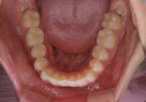 前歯のがたつきを改善してしっかり噛める歯並びへ:インビザライン治療の治療前