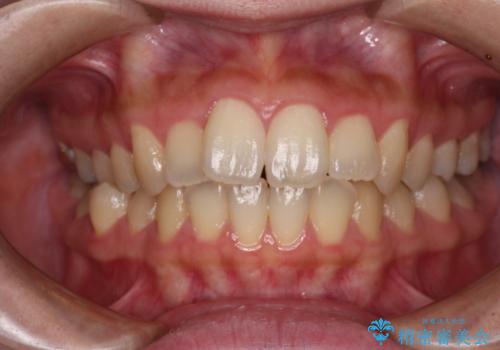 捻れた前歯をインビザラインでスッキリとの症例 治療前