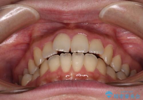 捻れた前歯をインビザラインでスッキリとの治療前