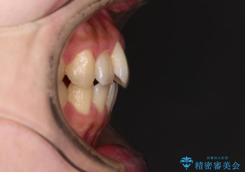 捻れた前歯をインビザラインでスッキリとの治療前