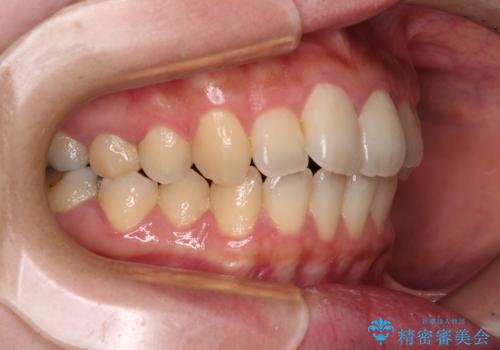 捻れた前歯をインビザラインでスッキリとの治療前