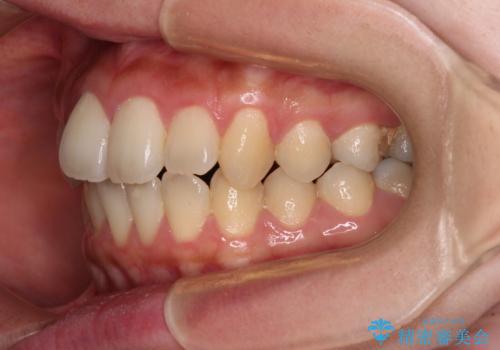 捻れた前歯をインビザラインでスッキリとの治療前