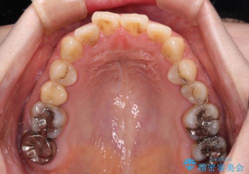捻れた前歯をインビザラインでスッキリとの治療前