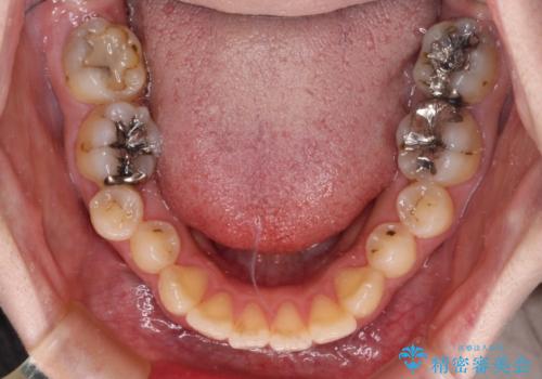 捻れた前歯をインビザラインでスッキリとの治療前