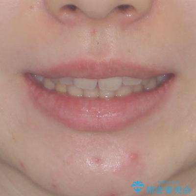 捻れた前歯をインビザラインでスッキリとの治療前(顔貌)