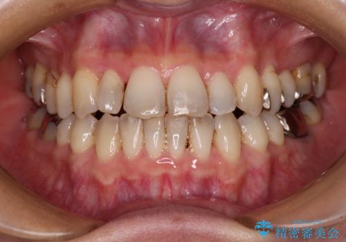 急速拡大装置 前歯の反対咬合をインビザラインで改善の治療中