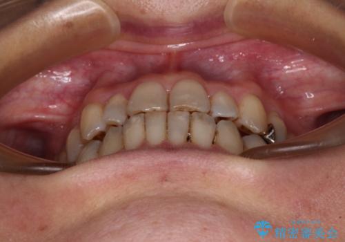 急速拡大装置 前歯の反対咬合をインビザラインで改善の治療中