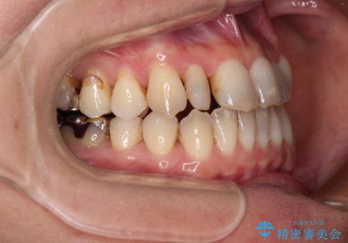 急速拡大装置 前歯の反対咬合をインビザラインで改善の治療中