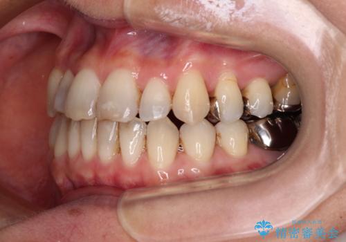急速拡大装置 前歯の反対咬合をインビザラインで改善の治療中