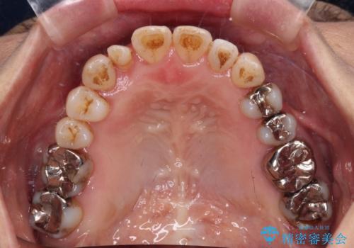 急速拡大装置 前歯の反対咬合をインビザラインで改善の治療中