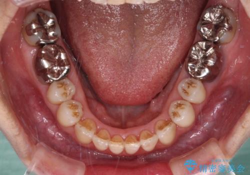 急速拡大装置　前歯の反対咬合をインビザラインで改善の治療中