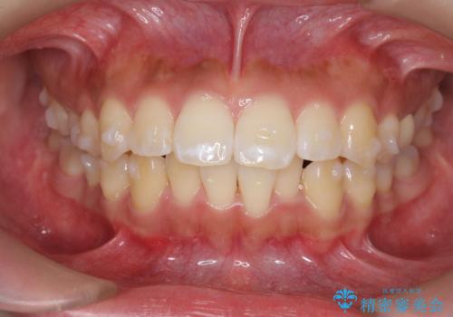 [ マウスピース矯正 ]  前歯の出っ歯感を改善したいの治療中