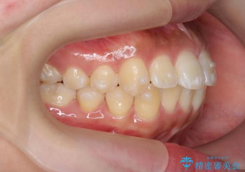 [ マウスピース矯正 ]  前歯の出っ歯感を改善したいの治療中