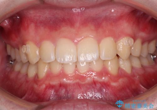 【モニター】斜めに突き出した前歯をインビザラインで改善の治療中