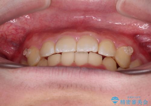 【モニター】斜めに突き出した前歯をインビザラインで改善の治療中