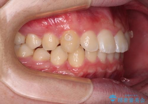 【モニター】斜めに突き出した前歯をインビザラインで改善の治療中