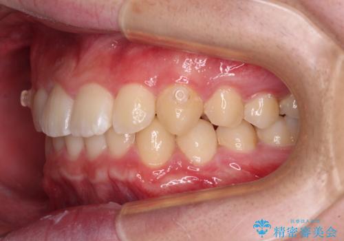 【モニター】斜めに突き出した前歯をインビザラインで改善の治療中