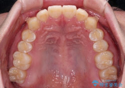 【モニター】斜めに突き出した前歯をインビザラインで改善の治療中