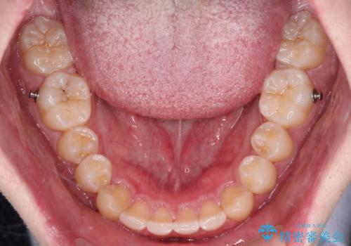 【モニター】斜めに突き出した前歯をインビザラインで改善の治療中