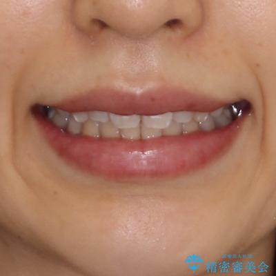 インビザライン・ライトで抜歯矯正の後戻りを解消の治療後(顔貌)