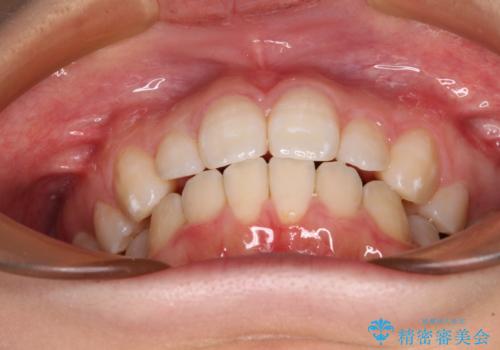 インビザライン・ライトで抜歯矯正の後戻りを解消の治療後