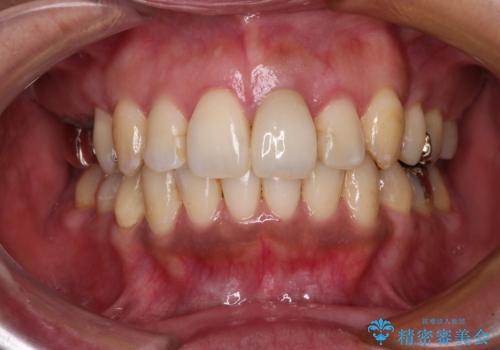 内側に倒れた前歯と口元の突出感 ワイヤー装置での抜歯矯正の症例 治療後