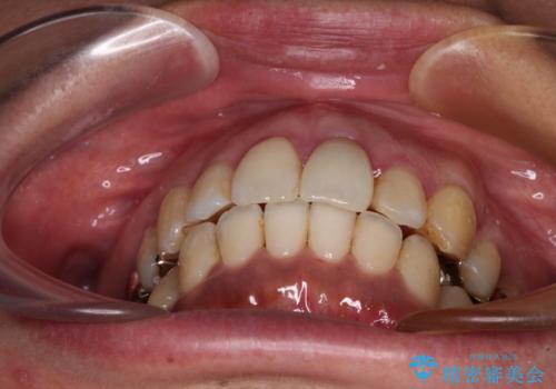 内側に倒れた前歯と口元の突出感 ワイヤー装置での抜歯矯正の治療後