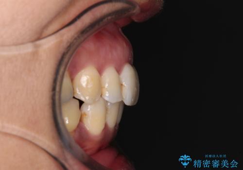 内側に倒れた前歯と口元の突出感 ワイヤー装置での抜歯矯正の治療後