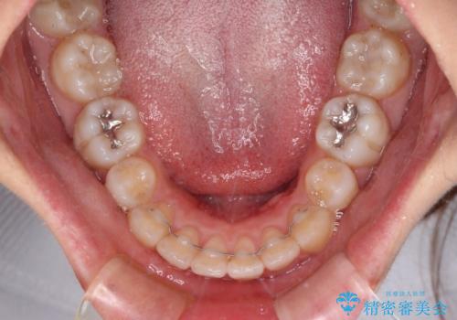 インビザライン・ライトで抜歯矯正の後戻りを解消の治療後