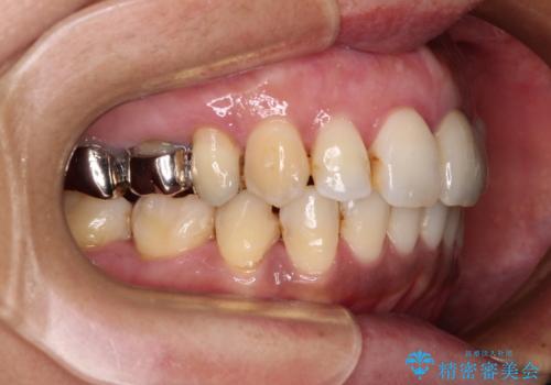 内側に倒れた前歯と口元の突出感　ワイヤー装置での抜歯矯正の治療後
