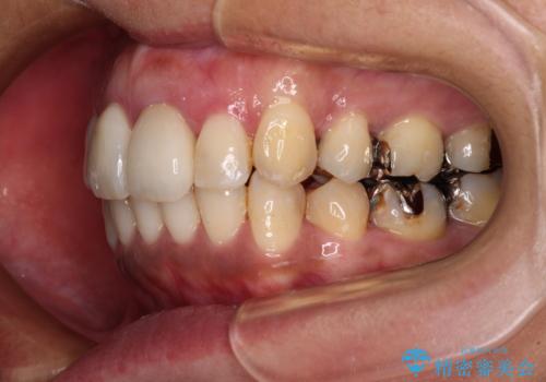 内側に倒れた前歯と口元の突出感 ワイヤー装置での抜歯矯正の治療後