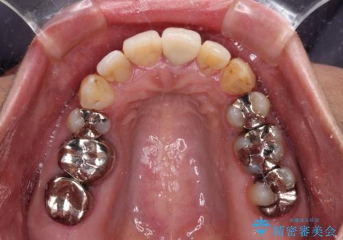 内側に倒れた前歯と口元の突出感　ワイヤー装置での抜歯矯正の治療後