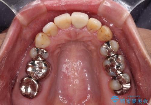 内側に倒れた前歯と口元の突出感 ワイヤー装置での抜歯矯正の治療後