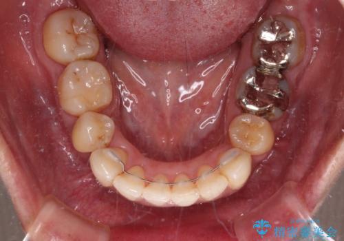 内側に倒れた前歯と口元の突出感 ワイヤー装置での抜歯矯正の治療後