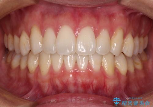 少しでも口元を閉じやすく インビザラインによる前突の解消の症例 治療後