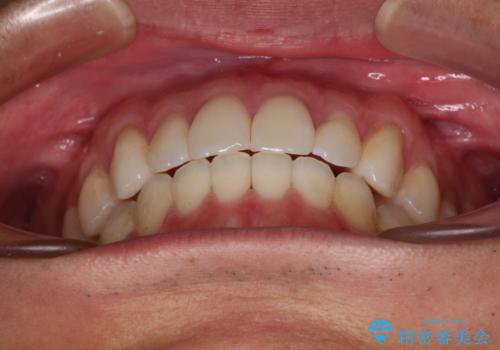 少しでも口元を閉じやすく インビザラインによる前突の解消の治療後