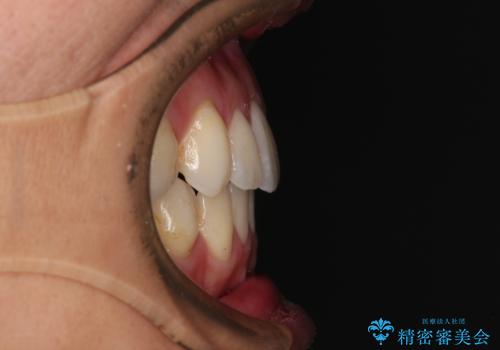 少しでも口元を閉じやすく インビザラインによる前突の解消の治療後