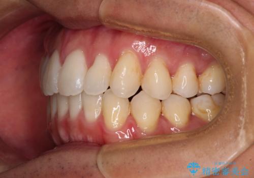 少しでも口元を閉じやすく インビザラインによる前突の解消の治療後