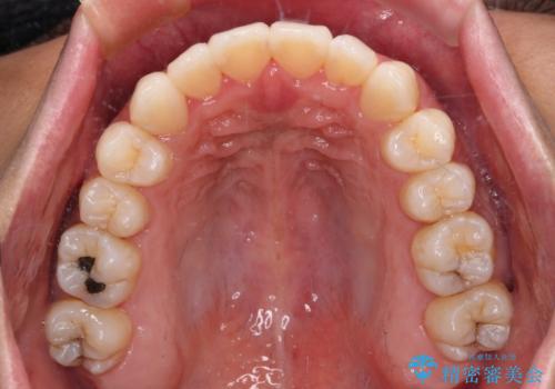 少しでも口元を閉じやすく インビザラインによる前突の解消の治療後