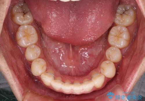 少しでも口元を閉じやすく インビザラインによる前突の解消の治療後