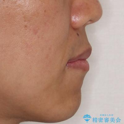 少しでも口元を閉じやすく インビザラインによる前突の解消の治療後(顔貌)