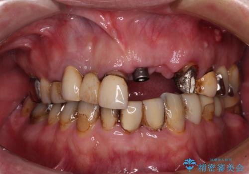 転倒で折れてしまった前歯 インプラントによるオールセラミックブリッジ治療の治療中