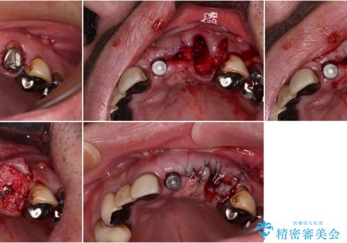 転倒で折れてしまった前歯 インプラントによるオールセラミックブリッジ治療の治療中