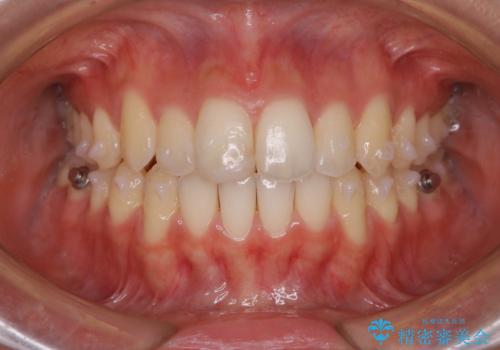 前歯のがたつきを改善してしっかり噛める歯並びへ:インビザライン治療の治療中