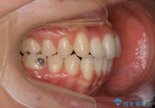 前歯のがたつきを改善してしっかり噛める歯並びへ:インビザライン治療の治療中