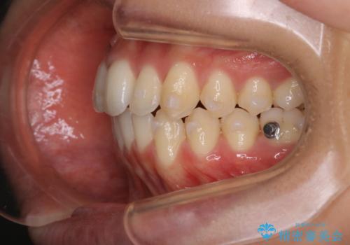 前歯のがたつきを改善してしっかり噛める歯並びへ:インビザライン治療の治療中