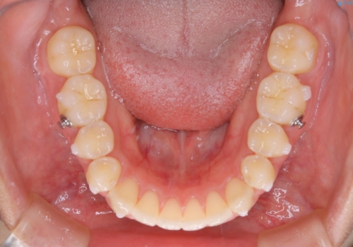 前歯のがたつきを改善してしっかり噛める歯並びへ:インビザライン治療の治療中